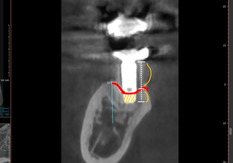 애써 심어둔 임플란트, 교체해야 된다구요? 냄새가 난다면 확인해보세요. 관련 이미지 8