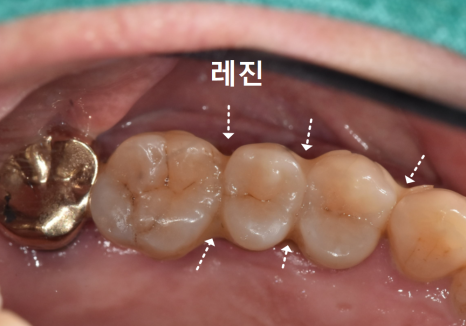 Gangil-dong Molar Implant, "It’s Loose—Can’t You Just Bond It with Resin?" image 3