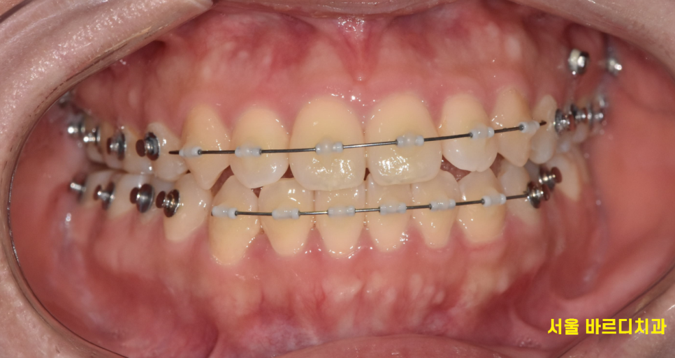 교정과 임플란트 동시에 해야한다면? 순서는? 관련 이미지 1