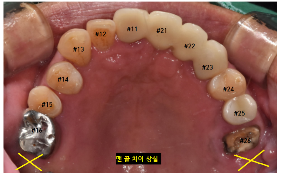 암사동 치과 임플란트 꼭 안 해도 되는 경우 궁금증 해결해 드려요 관련 이미지 11