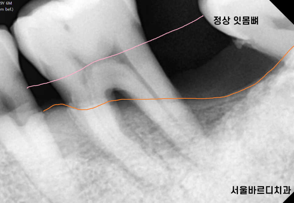 고덕 치과 잇몸 무너짐 천천히 진행되어서 더 무섭다. 관련 이미지 4
