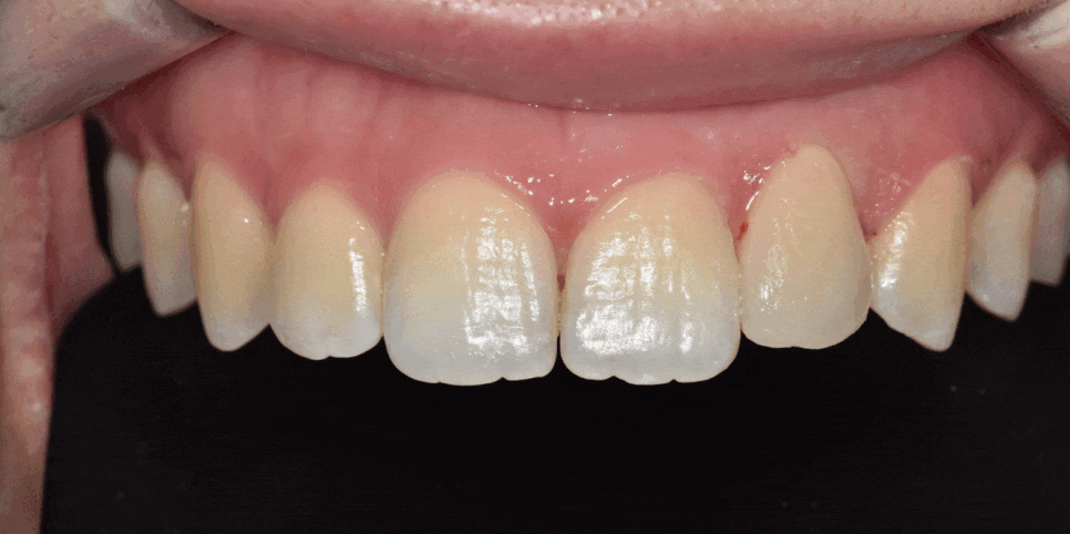 상일동역 라미네이트 치아 무삭제 정말 가능한가요? 관련 이미지 1