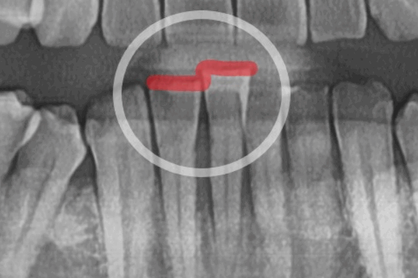 My Teeth Are Shaking So Much That Eating Is Uncomfortable—Is It Okay to Just Leave Them Alone? image 7