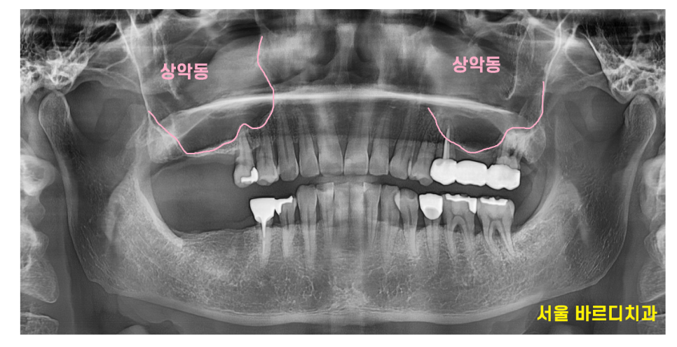 미사 임플란트 상악동 거상술 제일 어렵고 난이도가 높습니다. 관련 이미지 3