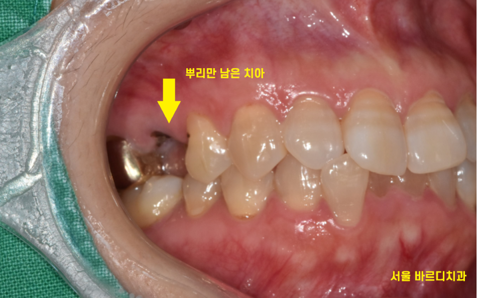 강동구 임플란트 치과 뿌리만 남은 치아 시작이 좋아야 끝도 좋으니까!! 관련 이미지 4