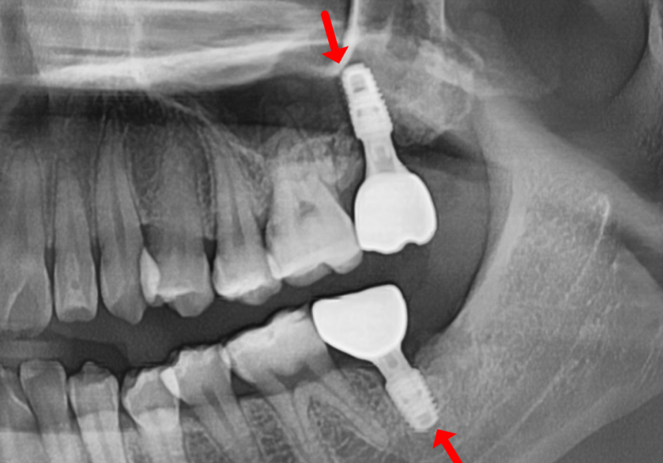 If you lightly brush your backmost molar because the toothbrush can’t reach it, this is what happens. image 18