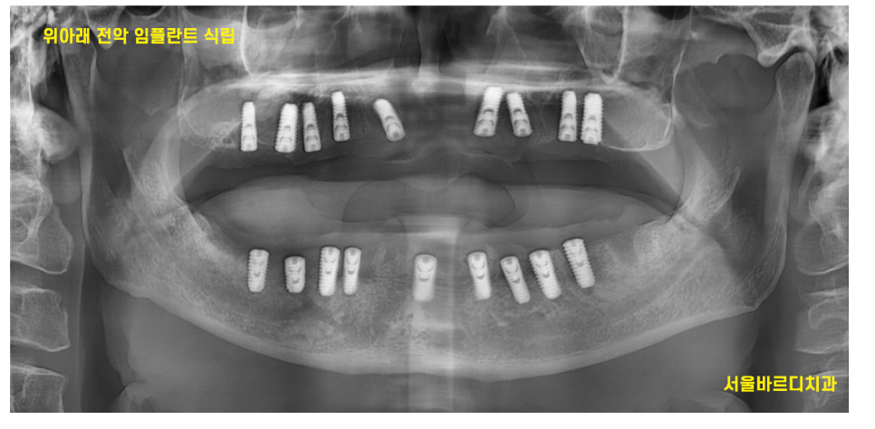 고덕역  치과 틀니쓰다 위아래 전악 임플란트 재건했습니다. 관련 이미지 6