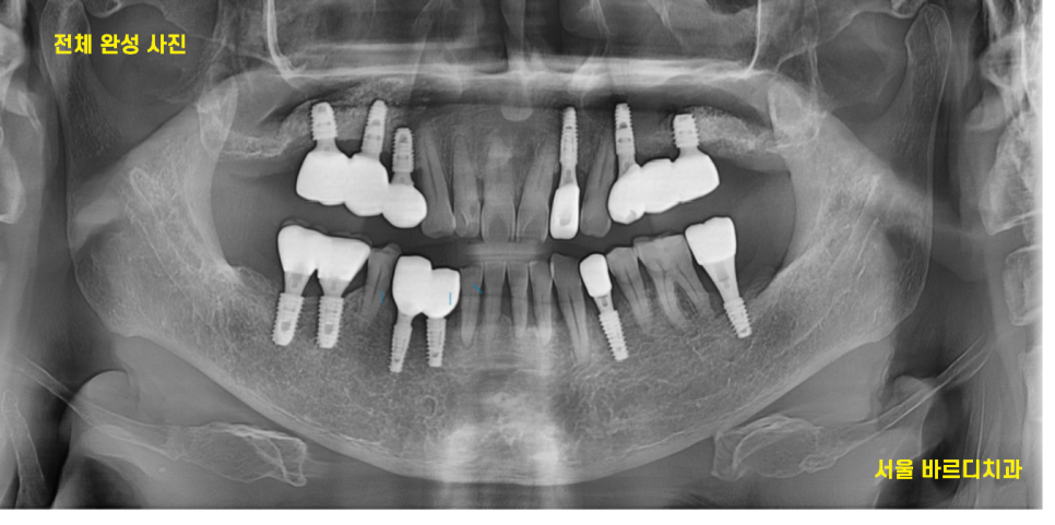 상일동역 근처 치과 타원 임플란트 제거 후 재식립 케이스 관련 이미지 10