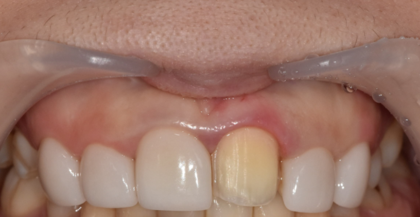 라미네이트 깨짐 원인 TOP 3, <대표원장>이 직접 알려드립니다 관련 이미지 4