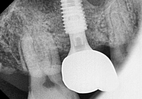 상일역 치과, 오래된 금니 빠짐, 같은 증상으로 내원했지만 전혀 다른 결과, 그 차이는? 관련 이미지 10