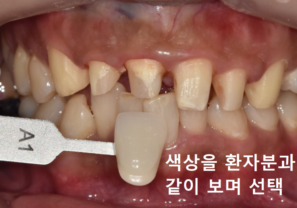A Single Black Spot of Decay Between the Front Teeth May Be a Warning Sign of Multiple Cavities. image 12