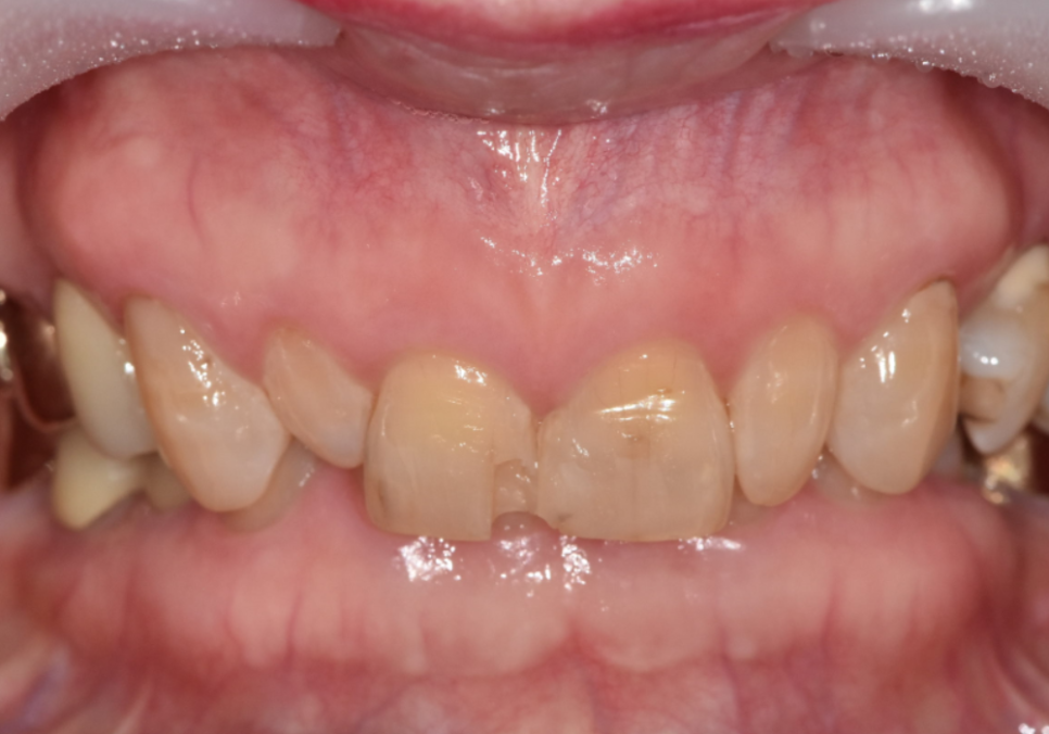 중장년 라미네이트, 70대도 가능한가요? 왜소치와 벌어진 앞니 해결 사례 관련 이미지 3