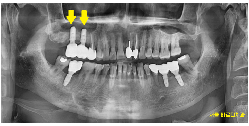 상일동 임플란트 치아 솟음으로 불편함을 느낄 때 관련 이미지 8
