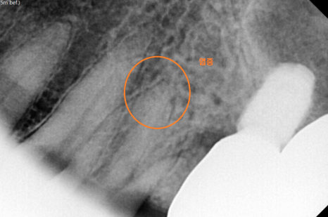 강일동 치과 전남 완도에서 올라오셔서 발치 후 당일 임플란트 완료하였습니다. 관련 이미지 5