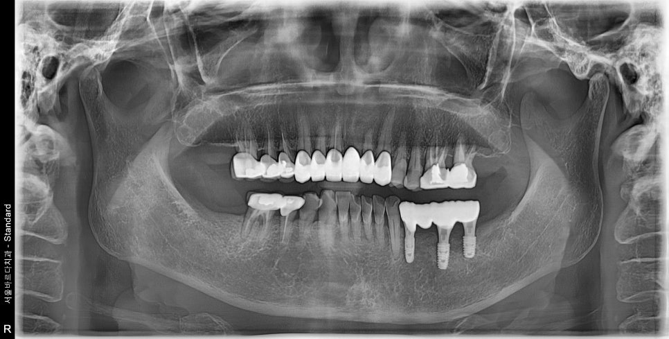 Godok Implant: Treatment That Reduced the Financial Burden with Insurance Implants for a Patient in Their 70s image 6