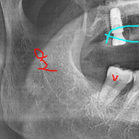 Sangil-dong Dentist: If a Problem Develops with an Implant, Does It Need to Be Replaced? image 7