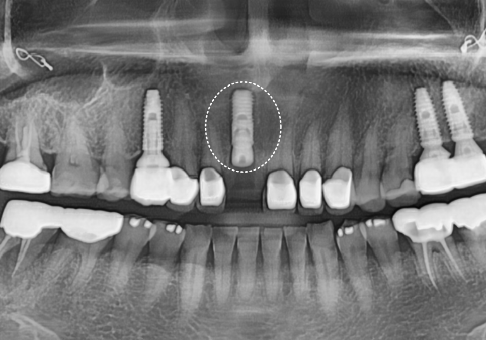 고덕동 앞니 보철, 브릿지와 싱글 크라운, 어떤 선택이 나에게 더 유리할까? 관련 이미지 16