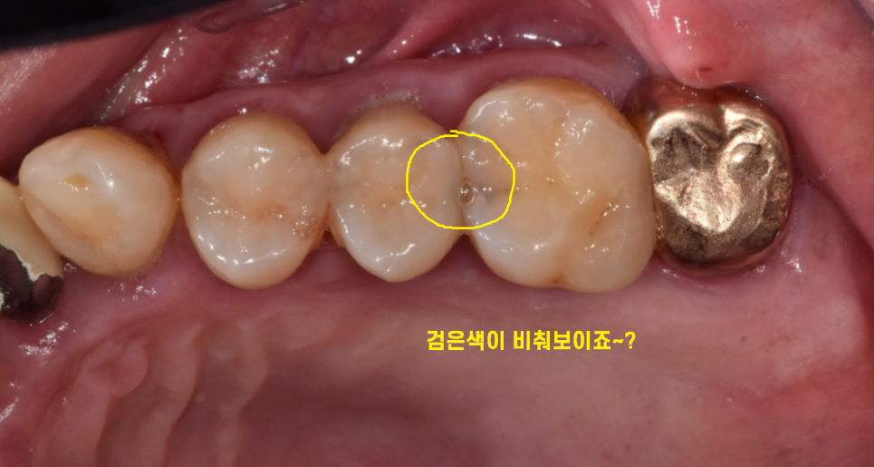 치과 엑스레이 꼭 찍어야하나요? 암사역 치과에서 답변드립니다. 관련 이미지 6
