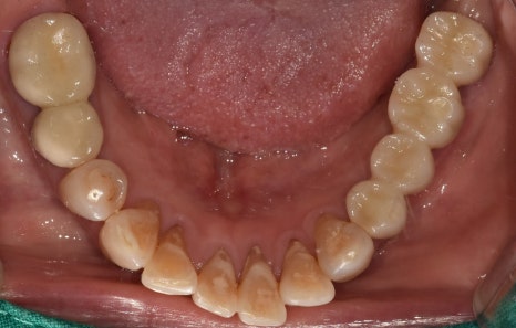 Godok Implant: Treatment That Reduced the Financial Burden with Insurance Implants for a Patient in Their 70s image 3