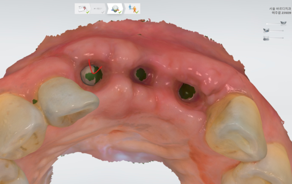 고덕동 임플란트, 튀어나온 앞니, 비용은 줄이고 자연스럽게 개선한 실제 사례 관련 이미지 12