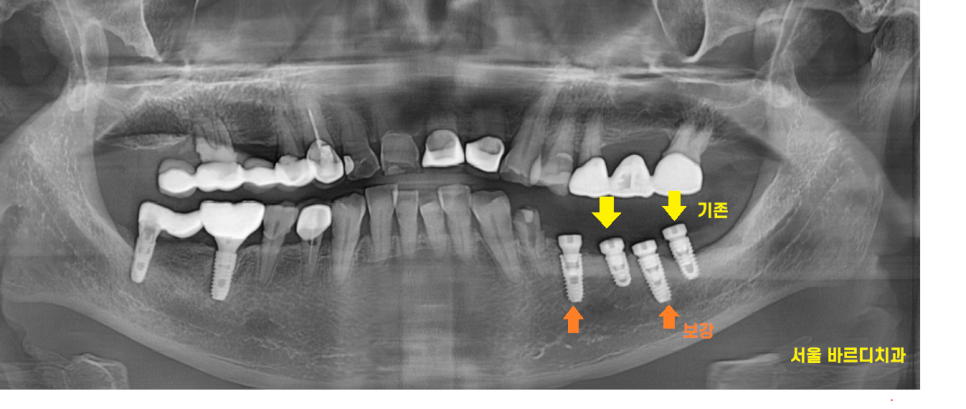 고덕동치과 이가 다 부서졌을 때 임플란트 치료했습니다. 관련 이미지 9