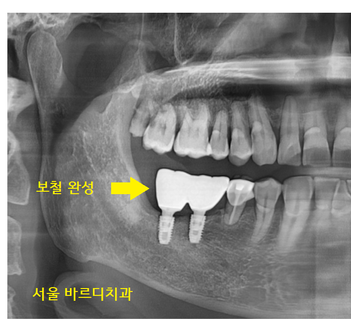강일역 치과 치아와 임플란트 연결 가능한가요??? 관련 이미지 8