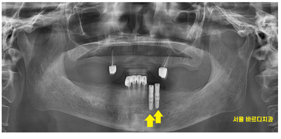 강일동 치과추천 틀니 사용중 치아 부러짐 임플란트로 복구했습니다. 관련 이미지 6