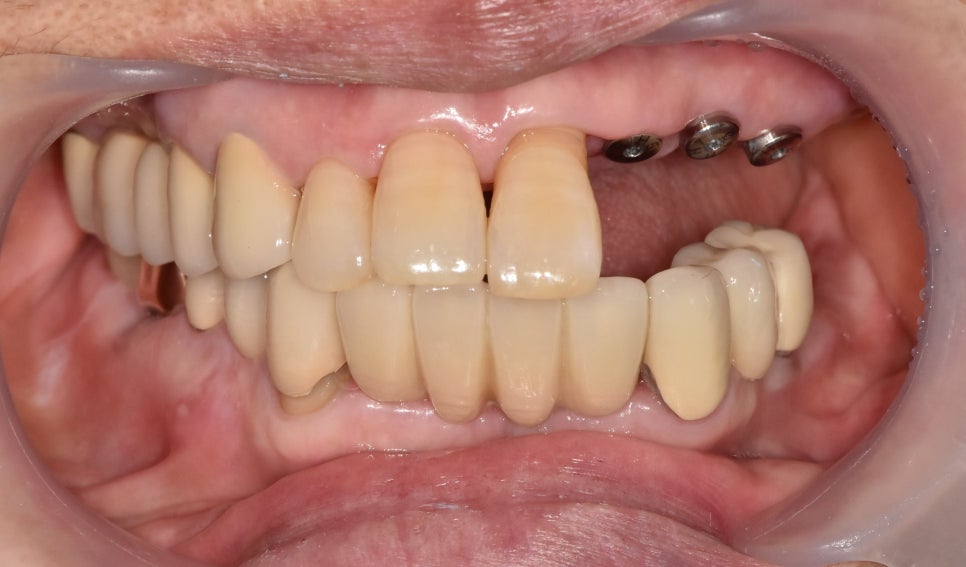 A Pimple Outside the Gums: Bridge Retreatment Implant Case Due to Bone Loss image 5