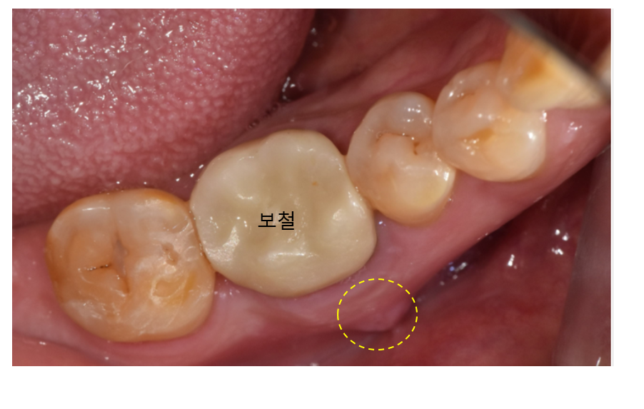 Implant treatment is needed when a gum pimple or pus appears. image 5