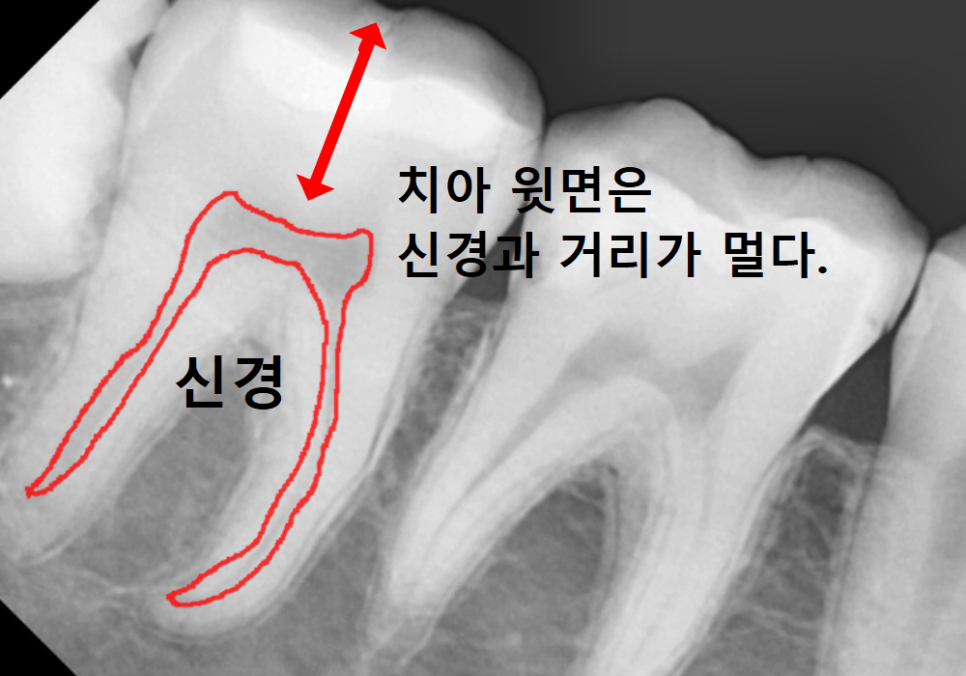 고덕동 사랑니 매복 발치, 안 아픈데 꼭 빼야 하나요? 관련 이미지 9