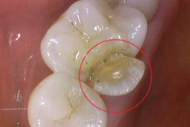 크라운 탈락 빠짐, 빠졌을 때 그대로 다시 붙일 수 있나요? 관련 이미지 5