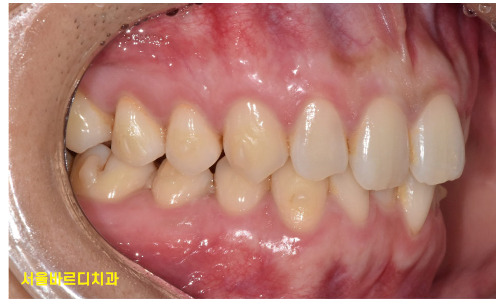 미사 치아교정 군인도 할 수 있을까요?? 투명교정을 추천합니다. 관련 이미지 4