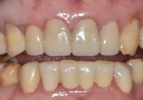 명일동 라미네이트 vs 크라운, 수명을 좌우하는 선택 기준 3가지 관련 이미지 14