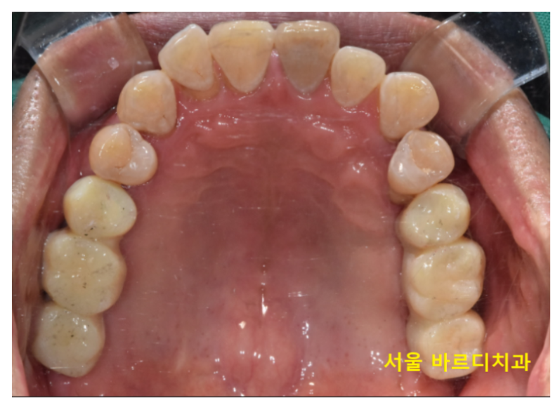 길동 치과 임플란트 뼈이식 흡연 관련 있을까? 관련 이미지 11
