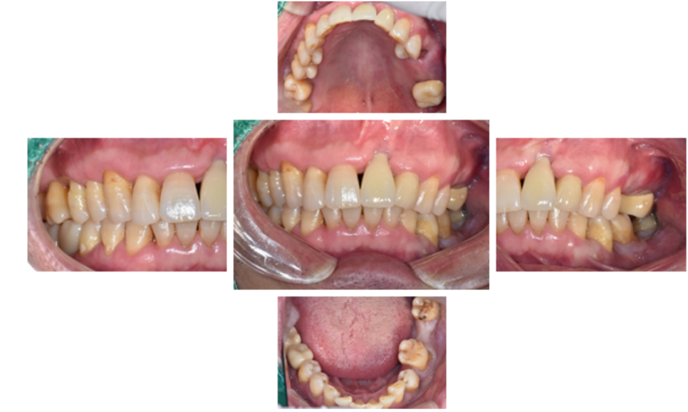 고덕동치과 서울바르디치과 전치부 및 구치부 임플란트 치료증례 #9 관련 이미지 18