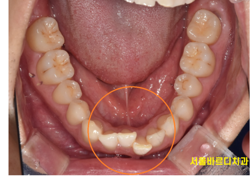 고덕동 교정치과 부정교합은 무엇인가요? 어떨때 치료가 필요한가요? 관련 이미지 2