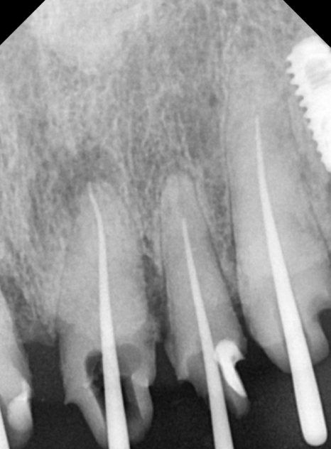 앞니 음식물 끼임, 왜 젊을 때보다 더 자주 발생하는 걸까요? 까맣게 변한 앞니 치료 사례 관련 이미지 12