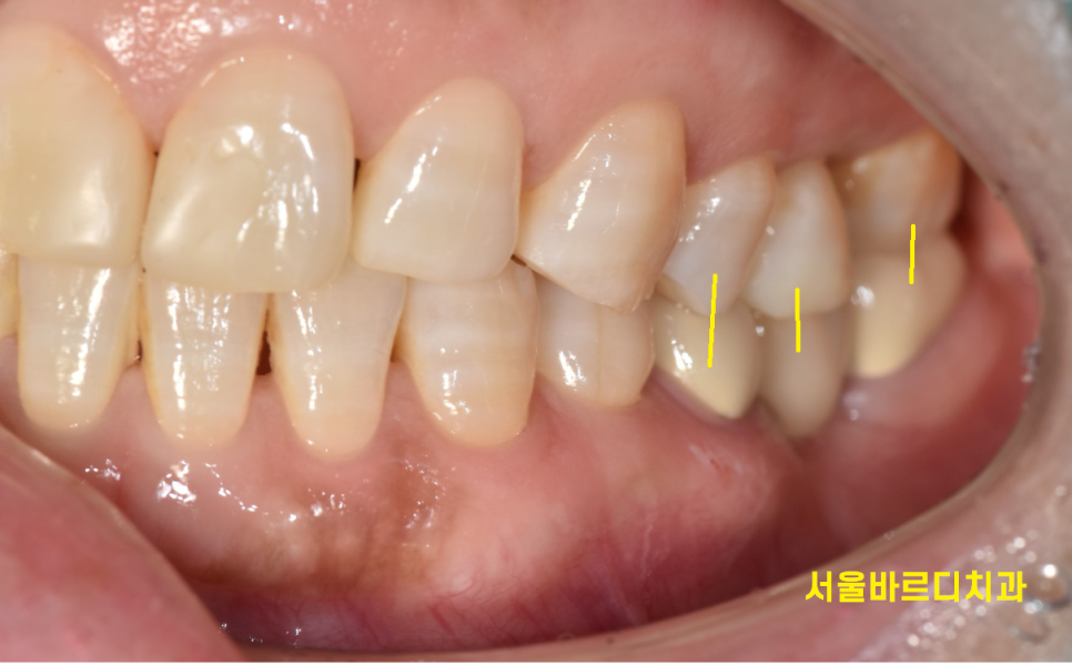 고덕동 교정치과 앞니 사이 틈 부분교정으로 치아 삭제없이 공간 없애기 관련 이미지 3