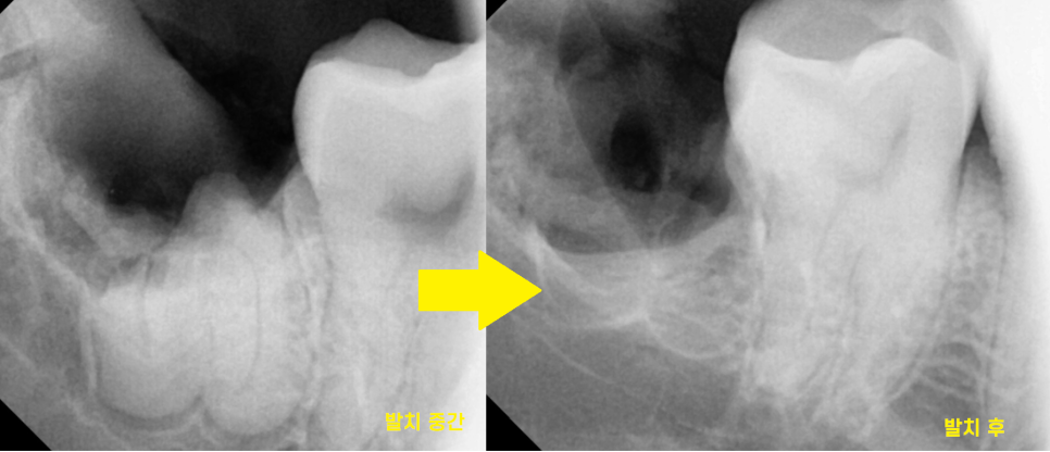 상일동 사랑니 맨날 뽑아야지는 그만!! 매복 치아도 깔끔하게 뽑으세요 관련 이미지 8