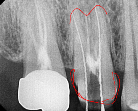 발치 대신 신경치료 뽑기 전 치료는 한번 해봐야하지않을까요? 관련 이미지 7