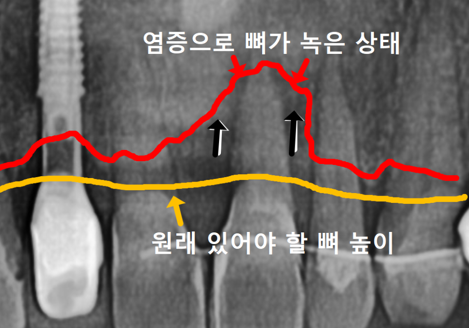 앞니 흔들림, 임플란트 치아보험 감액 기간 넘기려다 더 큰 손해 봅니다. 관련 이미지 1