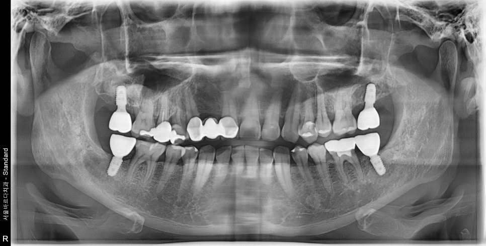상일동치과 서울바르디치과 무절개 네비게이션 임플란트 치료증례 #7 관련 이미지 8