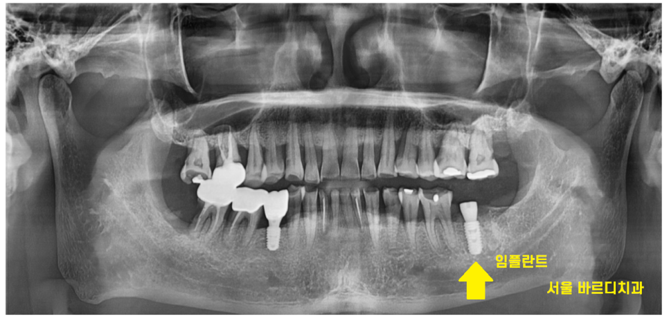 망월동 치과 신경치료 후 보철 꼭 씌워야 하나요?? 관련 이미지 8