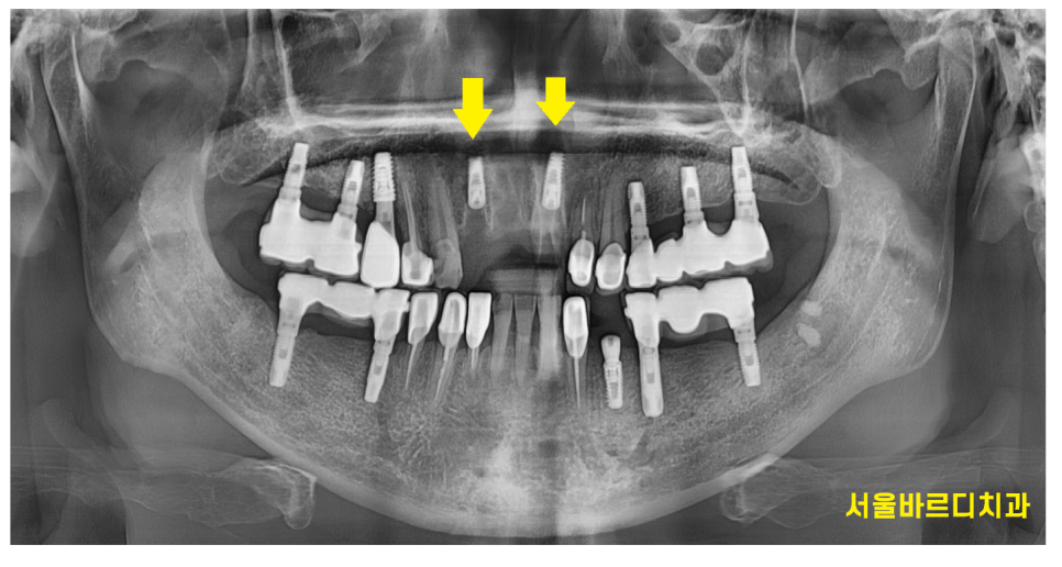 상일동역 치과 부러진 앞니 임플란트로 복구하기 프로젝트 관련 이미지 7