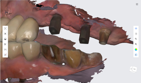 네비게이션 임플란트가 왜 좋다고 그러는거죠? (feat.13가지 장점) 관련 이미지 14