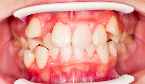 고덕동 교정치과 부정교합은 무엇인가요? 어떨때 치료가 필요한가요? 관련 이미지 1