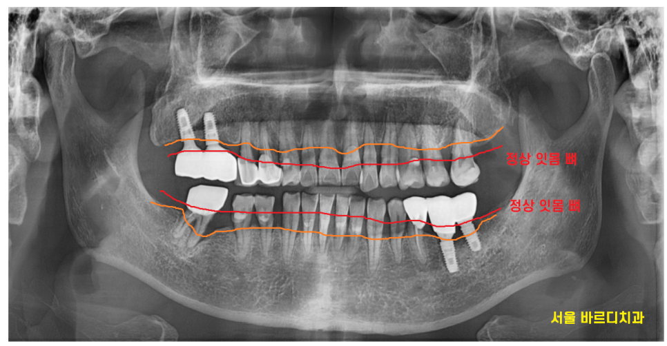 강일동 임플란트 위아래 치아 흔들림과 통증이 있을 때 방법은? 관련 이미지 2