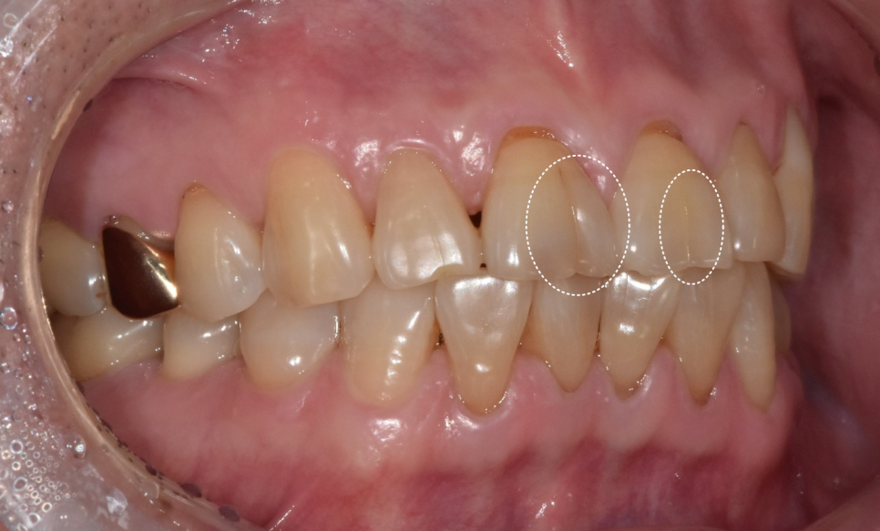 앞니 금 갔을 때, 방치하면 안 되는 진짜 이유 <파절 치료 사례> 관련 이미지 6