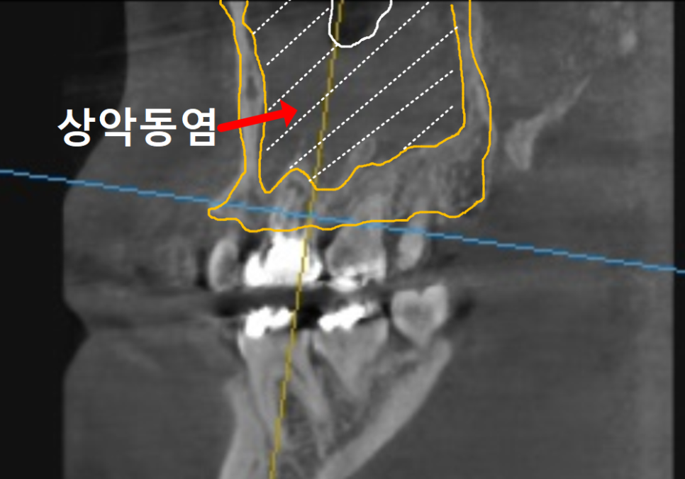 Sinusitis Caused by Teeth: Why Do You Tell Me to Go to the Dentist When My Nose Hurts? image 4