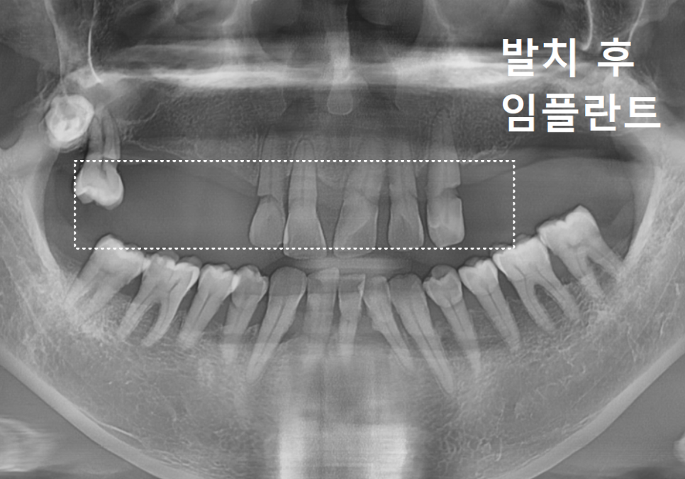 위 턱 전체 임플란트 vs 부분 틀니, 나에게 꼭 필요한 치료법 찾기 관련 이미지 6